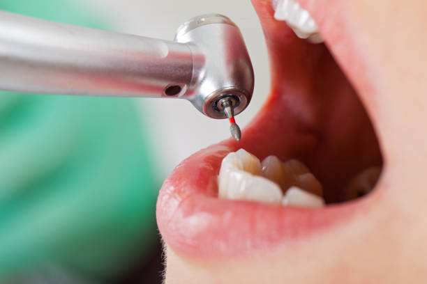 Best Lost Filling or Crown Replacement in Geneva, NY
